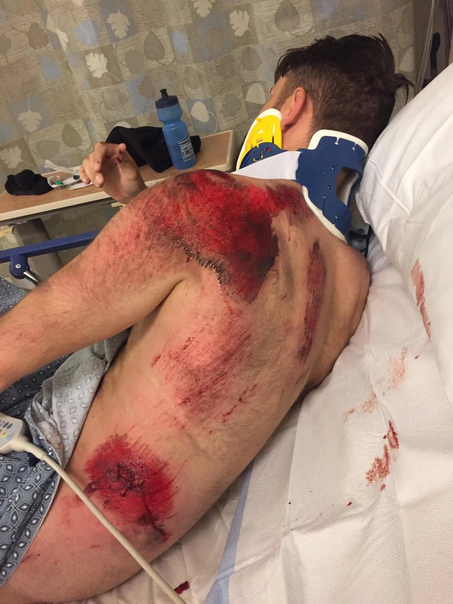 Guys and girls of the biker world wear your leathers for fuck sack. My boys son was on his bike sat at light n got taken out n look at him (this was last yr thou) sun is hot yes but leathers keeps yr skin wear it should be not on the tarmac ok. #RIDESAFE