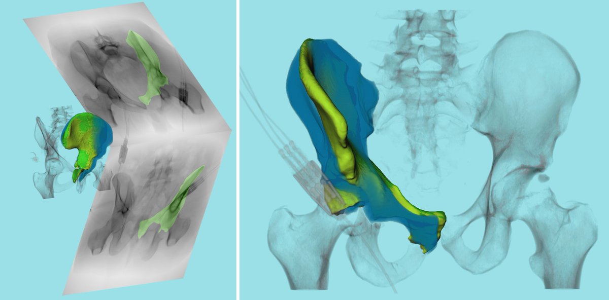 FraunhoferMEVIS's tweet photo. 2D-3D #ImageRegistration approach for determining fragment position during pelvic fracture procedures: learn more in our talk at CARS 2023 in #Munich. https://t.co/meQijiCjvk
#XRay #CT #Orthopedics https://t.co/Vw6dBmyVef