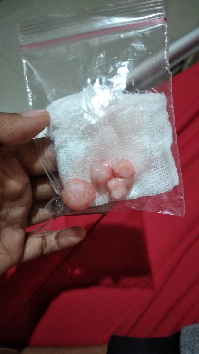 krna dri kemarin rame jg lewat di tl ku perkara tumor payudara yg trnyta makin hari makin bnyk kasusnya. mauka share sedikit ceritaku jdi penderita FAM yg ku smpn sndiri stahun lbh tnpa kasi tau siapa2:))