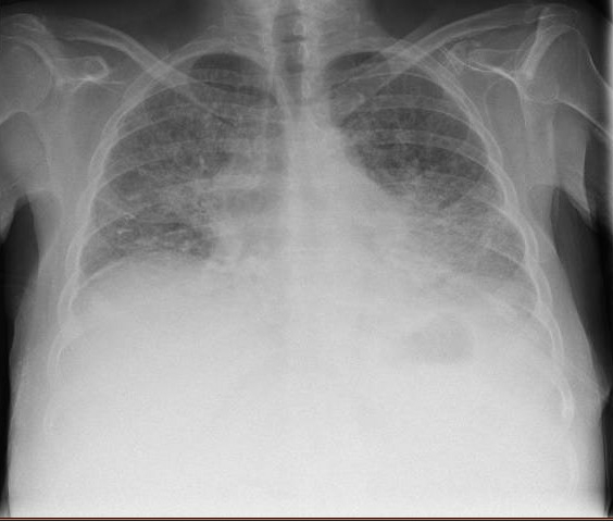 ShivRoyal's tweet photo. #VRSed #USGRA GA IS NOT AN OPTION: Non-Pharmacological Sedation in ASA-IV patient in mid 50s. Pulmonary Hypertension on 24x7 O2, Poor PFTs (Image), Unable to lie down and Difficult Airway (MP-4) Hand Recon Surgery (Darrach's and Tendon Transfer). Done with elbow block and Sedakit https://t.co/mXeVXZDM4H