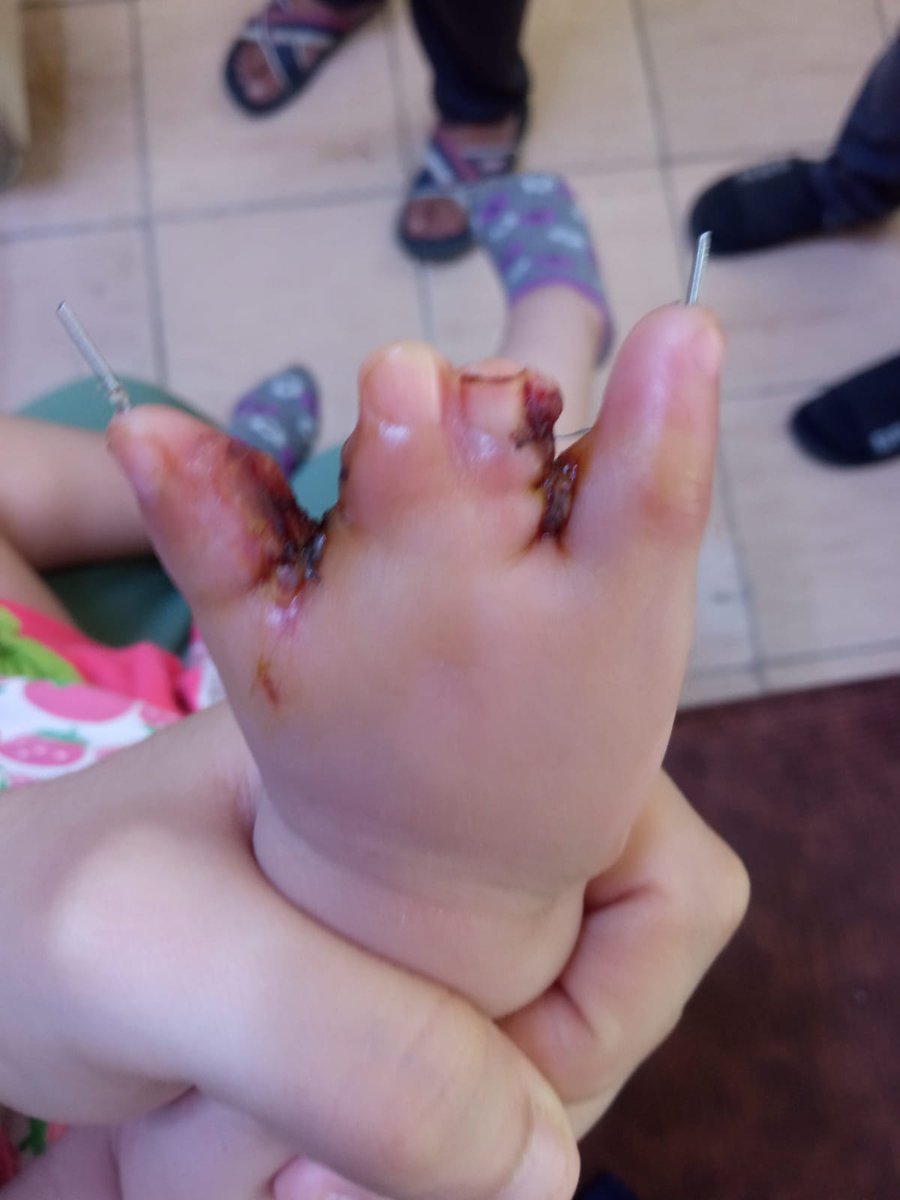 ummpasa01's tweet photo. İki hafta zamanımız kaldı 50bin lira gerek ikinci operasyon için bı yıl sonrada bı ameliyat daha geçirecek Alllah için sadece RT yapmayın destek olun görmezden gelmeyin
@babas_ibrahimin 
@Birgarip88 
@Davet_ve_Esas 
@7anabilahh 
@ebru7747 @enstkr1 @fizilalikuran2 https://t.co/T1bMcLdL8A