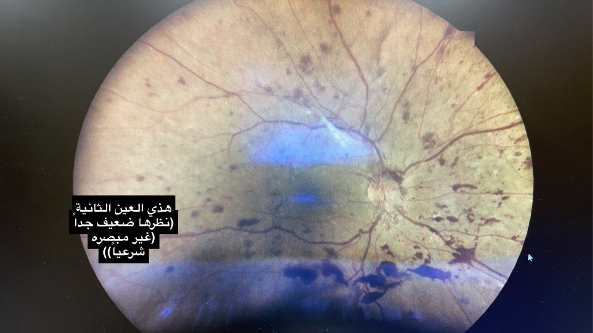 AlFakhriA's tweet photo. اعتلال الشبكية السكري قد يكون في مرحلة متقدمة مع بقاء النظر ٦/٦ حتى (لاسمح الله) يحصل مضاعفات خطيرة على مركز الابصار ويتأثر الشوف بشكل مفاجئ

المراجع شخص بالسكر قبل ١٣ سنة وعمل فحص شبكية واحد قبل ٩ سنوات ، أدعوا له بالشفاء 

#صحة_العيون 
#صوت_الطبيب https://t.co/y6DojIcclU