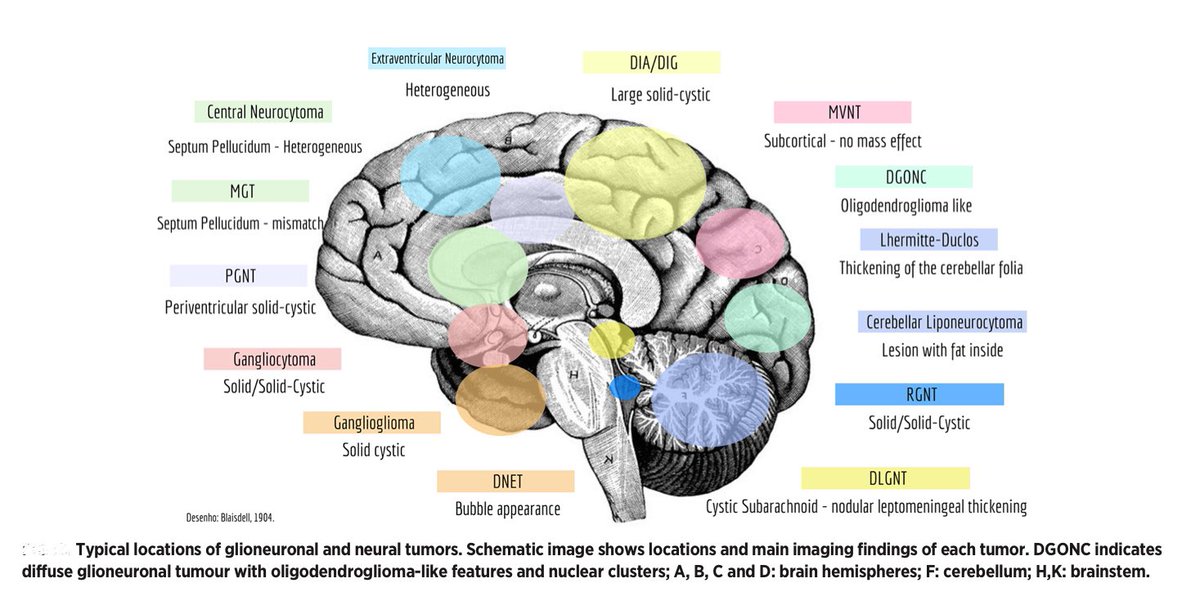 Glioneuronal and Neuronal Tumors: Who? When? Where? An Update Based on the 2021 World Health Organization Classification

Neurographics 2023 January-March;13(1):1–14

dx.doi.org/10.3174/ng.210…