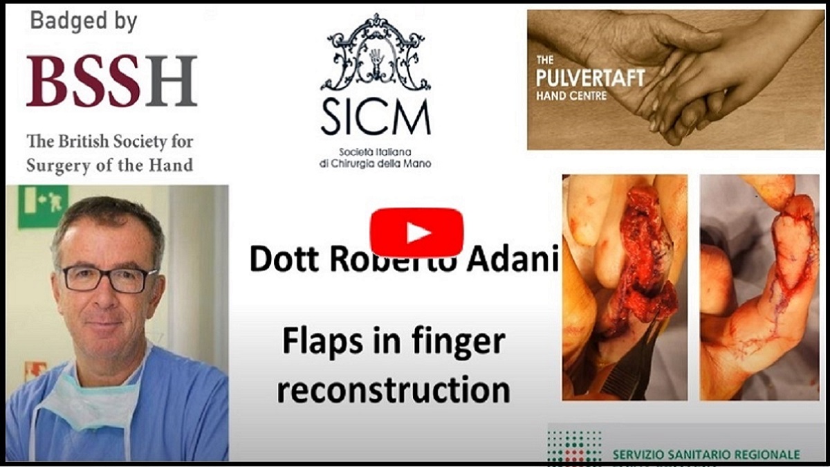 ipokrate's tweet photo. Flaps in Finger Reconstruction by Dr. Roberto Adani

Watch and learn today from the Pulvertaft Videos series on "Soft tissue cover to reconstruct fingers and thumb including pedicle flaps and free flaps."

https://t.co/Lv3GG4mjyH

#ipokrate #conference #doctor https://t.co/otvZQPUuJ3