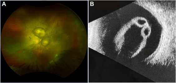 An Intraocular Spectacle: #retina macrocyst from total #RetinalDetachment #EyeTwitter ow.ly/2RGG50OxuQm