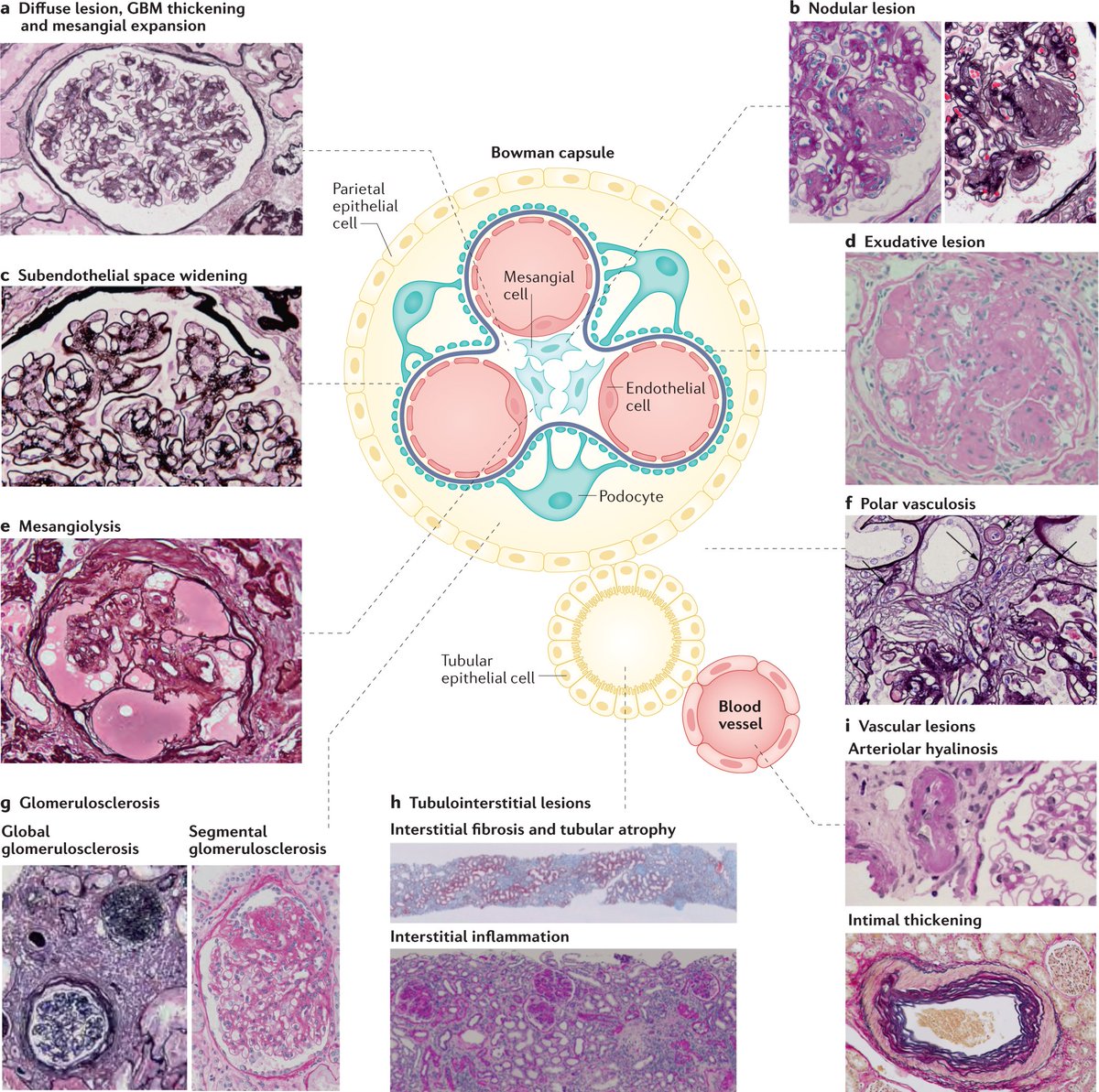 Trajectories of kidney function in diabetes go.nature.com/3iqUjuo