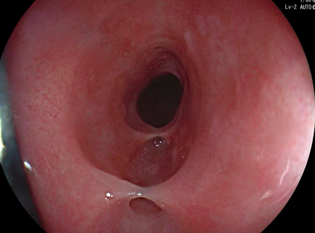 JJFordeMD's tweet photo. Interesting finding on EGD and barium swallow for evaluation of dysphagia in a 70 yo M. What is the name of this interesting phenomenon? #gitwitwitter #MedTwitter https://t.co/FzSduVy13i