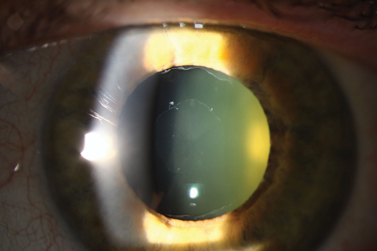 revoptom's tweet photo. Pseudoexfoliation Syndrome Linked with Alzheimer’s 🧠
As indicated by higher instances of brain atrophy, patients displayed greater rates of the neurodegenerative disease.
https://t.co/iqCDPtDeBj
#alzheimers #alzheimersdisease #optometry #retina #eyecare #amd https://t.co/Mi6LycelpS