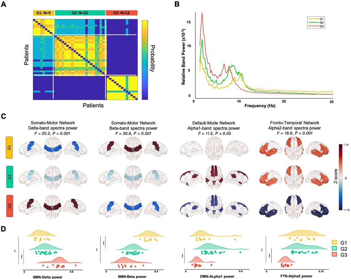 ScienceofPD's tweet image. New report from @sahar__yassine @MahmoodHacan &amp;amp; colleagues identifies #Parkinsons subtypes based on resting-state electroencephalography signatures that may provide a more accurate prognosis in patients &amp;amp; help to stratify subgroups in clinical trials
…mentdisorders.onlinelibrary.wiley.com/doi/10.1002/md…