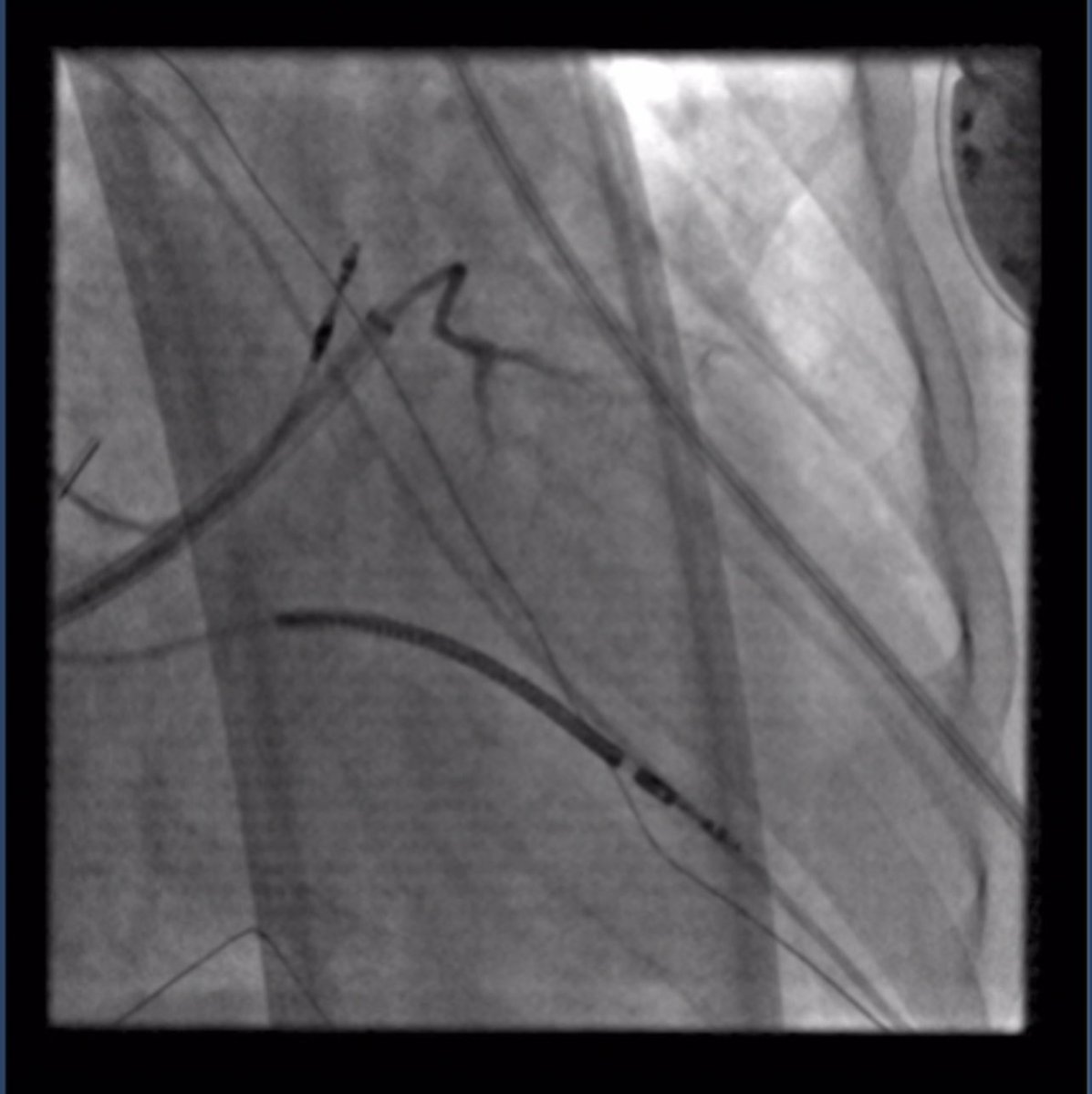 FergieLosiniec1's tweet photo. LV summit PVC today tackled with the best team! Thanks @mbelshazly for letting me be so hands on and learn so much from you! As a first year EP fellow I got to perform alcohol ablation to a septal branch of the AIV on this normal Tuesday. No PVCs after infusion. https://t.co/XgyGi2kuOI