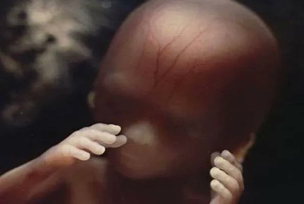 RT @LifeNewsToo: Judge Says Nebraska Law Can Keep Saving Babies From Abortions https://t.co/FVHWHUhoBw https://t.co/05YtWu7w2f
