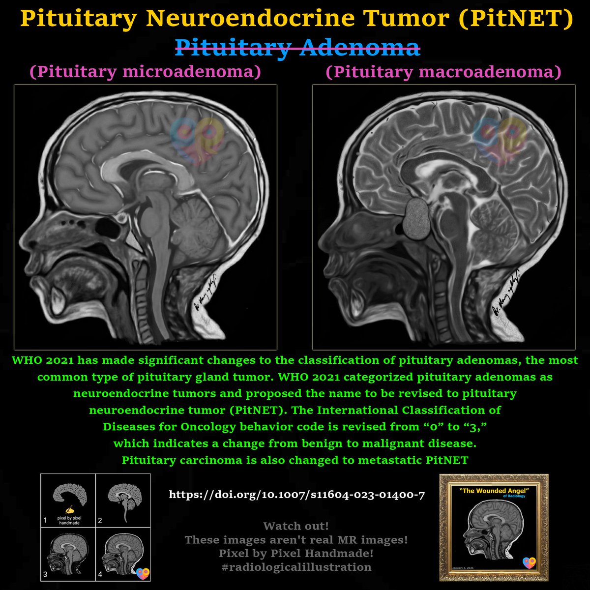 Pituitary Neuroendocrine Tumor (PitNET) 

doi.org/10.1007/s11604… 

#radiologicalillustration ✍️