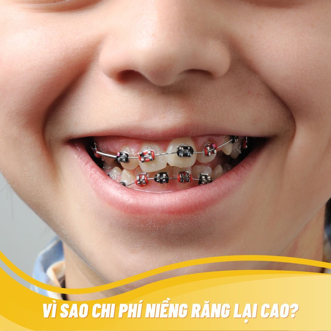 VÌ SAO CHI PHÍ NIỀNG RĂNG LẠI CAO?
Để cải thiện tình trạng sai lệch hàm răng cần một thời gian khá dài để nắn chỉnh, dịch chuyển răng dần dần đến vị trí mong muốn. 
Tìm hiểu thêm : bit.ly/3WCjM6u