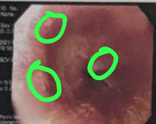 27/M. Persistent symptoms of reflux/dysphagia/ Globus sensation.
On PPIs BD for ~2 years. High dose PPI BD for 3 months. Persistent symptoms.
Ugie - velvety mucosa proximal to GEJ - heterotropic gastric mucosa on biopsy.