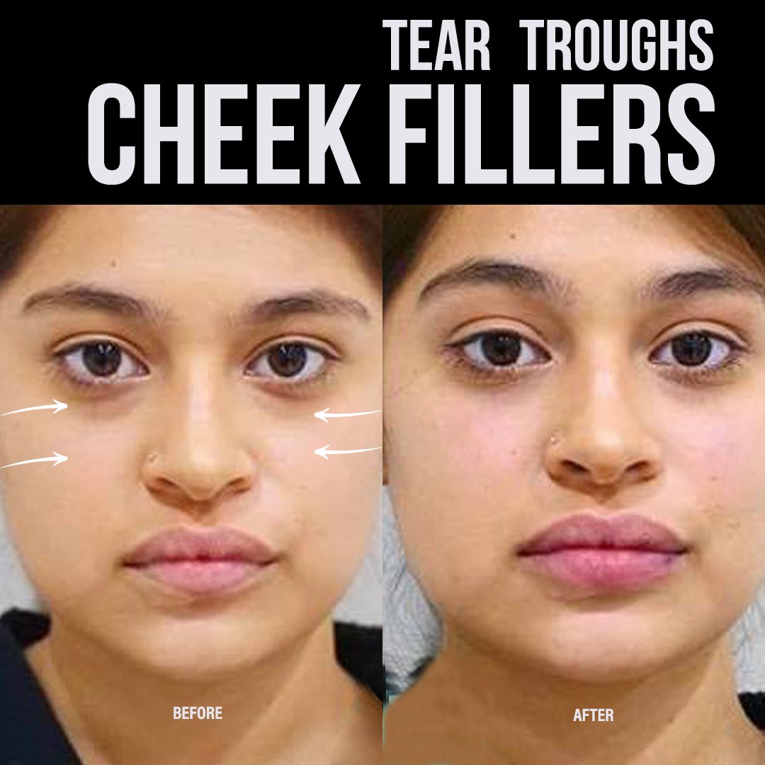 GeminiPlastics's tweet photo. Facial Balancing: #TearTroughs, Cheek Fillers
https://t.co/xBBvEutrUN
#cheeks #cheekfillers #fillers #beforeandafter #happy #balanced #allergan #merzaesthetics #balancedface #hispanicgirls #spanish #latina #latinos #cirujanoplastico #cosmeticinjector https://t.co/rJi36HcZO2