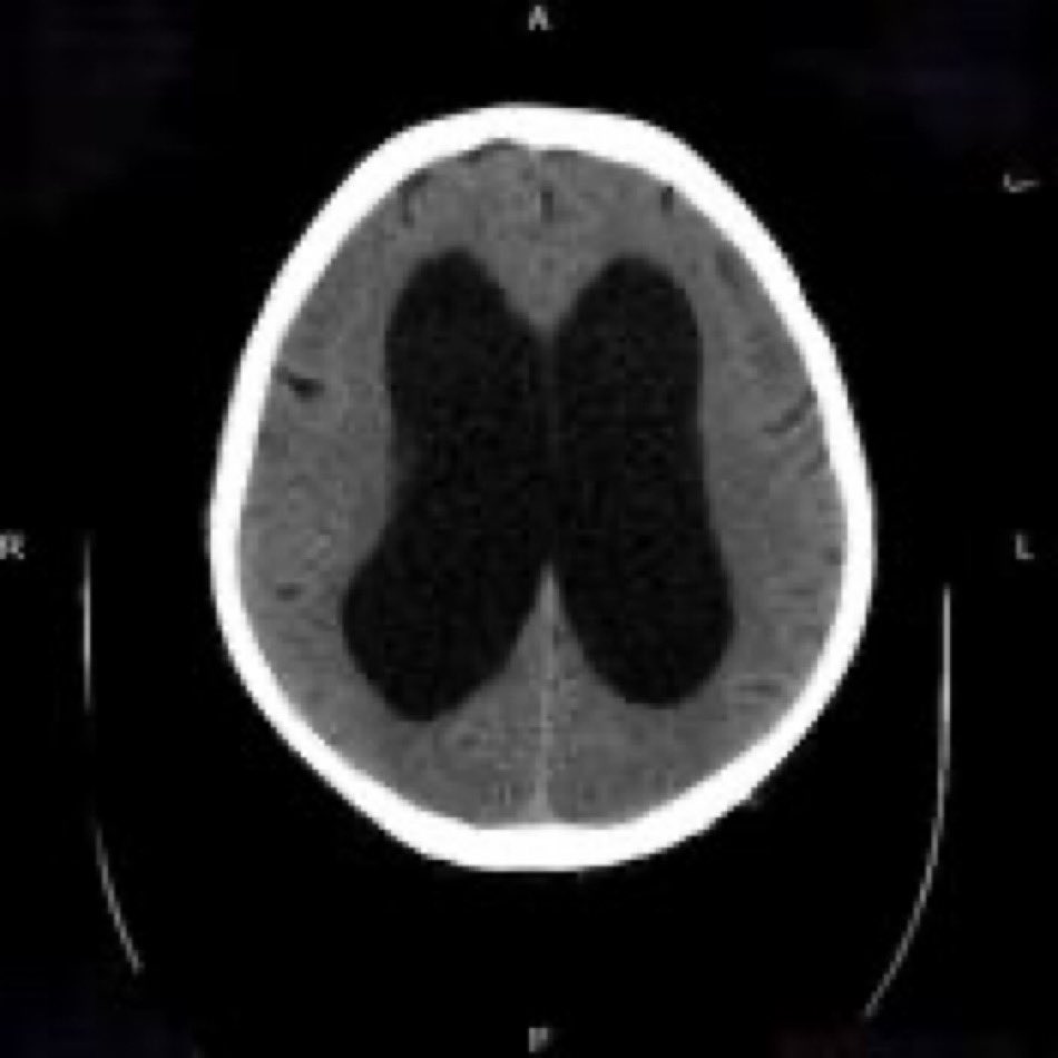 An elderly patient with recent diagnosis of dementia presented for evaluation of recurrent falls & new urinary incontinence. Family said the pt walks in a wobbly manner. LP with normal opening pressure. What is the likely diagnosis? #Medtwitter