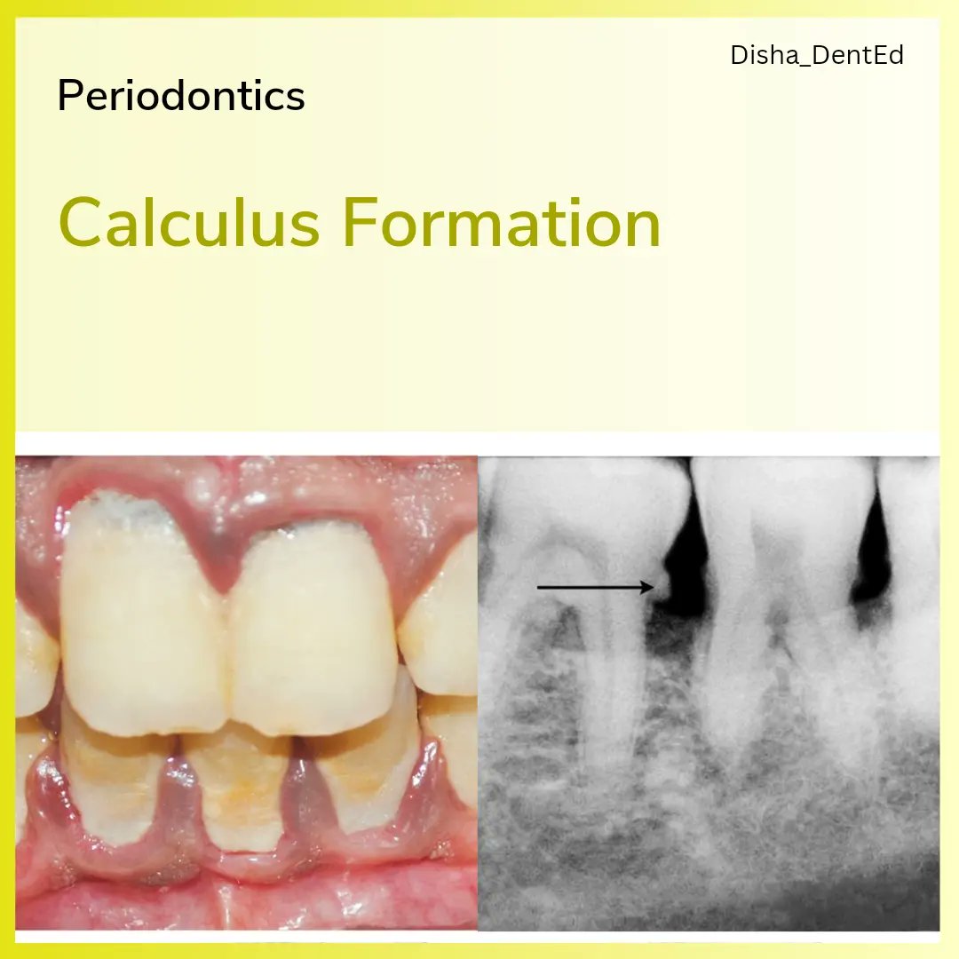 Disha_DentEd's tweet photo. Periodontics: Calculus Formation

1. Definition
2. Types
3. Composition
4. Attachment to tooth structure 
5. Formation of Calculus
6. Theories of Calculus formation
- Booster Mechanism
- Heterogeneous Nucleation 

#dentistry #dentalstudent #dentalnotes #dentalexam #periodontics https://t.co/lZhdVkRdnC