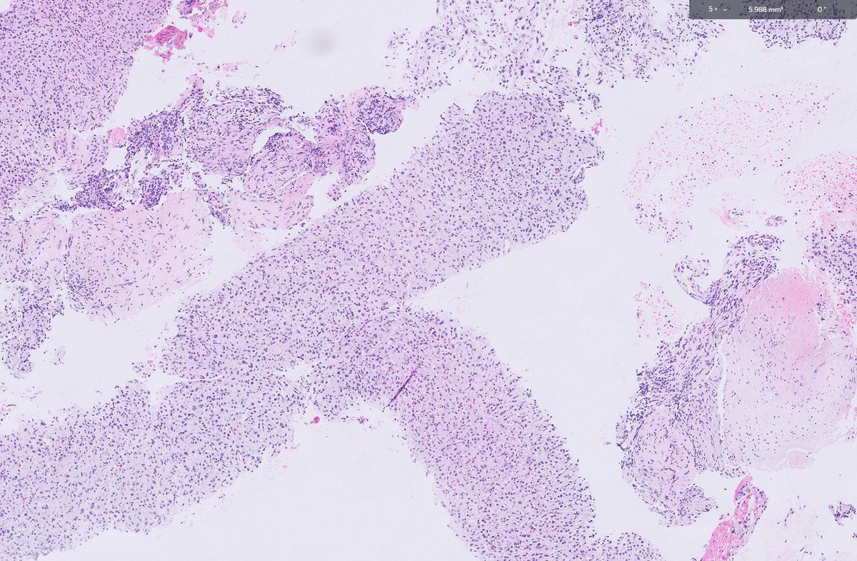 Gastric mass 
#PathTwitter #pathology #GIpath