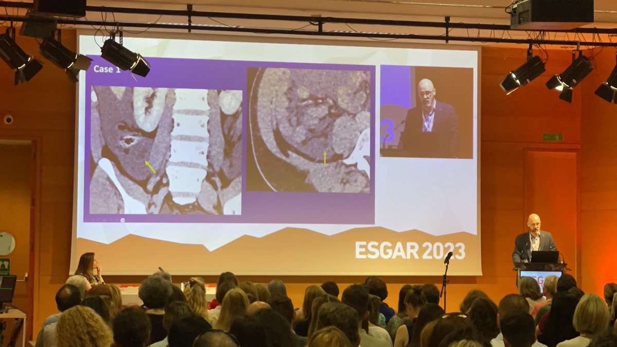 Expert in all things peritoneal based @ajthrower from the world renowned Basingstoke institute is also currently giving an ESGAR tutorial on primary and secondary peritoneal malignancies ! 

So much good content it's hard to keep up, but we have 👀 everywhere!

#esgar2023