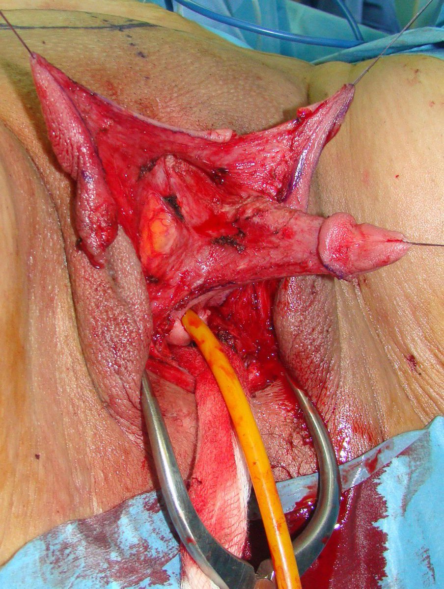 DrLoupis's tweet photo. WARNING, Graphic Content⚠️⚠️⚠️

Men are becomming disabled for life due to this procedure - Vaginoplasty. 

When they realize it was a scam and it didn’t change their sex, it’s too late and they’ll have to live with the consequences for the rest of their lives. 

Remember that a sex organ has VITAL FUNCTIONS of: 

-Urination.
-Sexual functioning.
-Reproduction.

This is NOT a sex change - this is genital mutilation surgery!