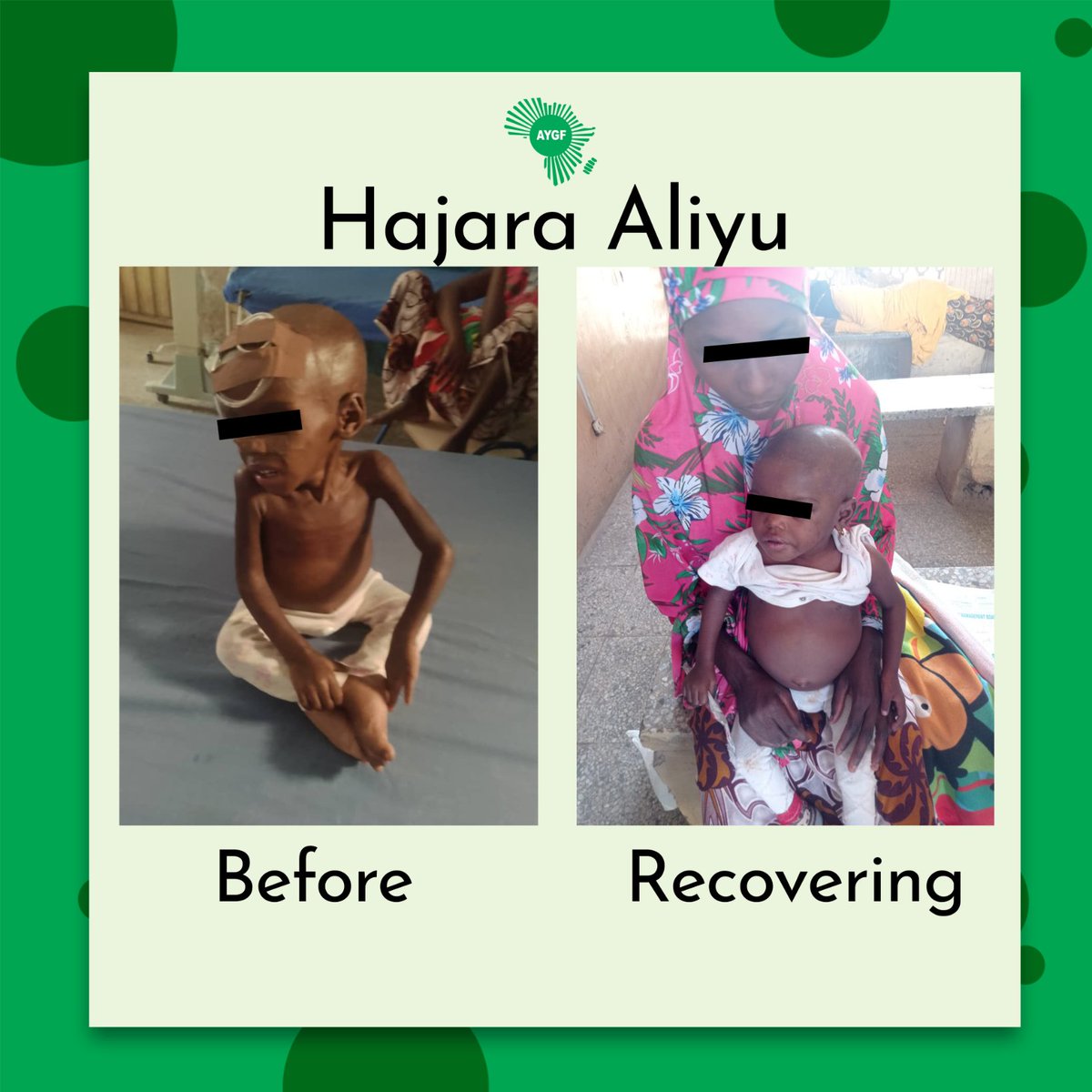 #SuccessStory  
The life of Baby Hajara Aliyu has been successfully transformed through the AYGF-ANRiN project by providing essential nutritional services to win this fight against #Malnutrition.

#PublicHealthMatters 
#AYGF
#ChildHealth