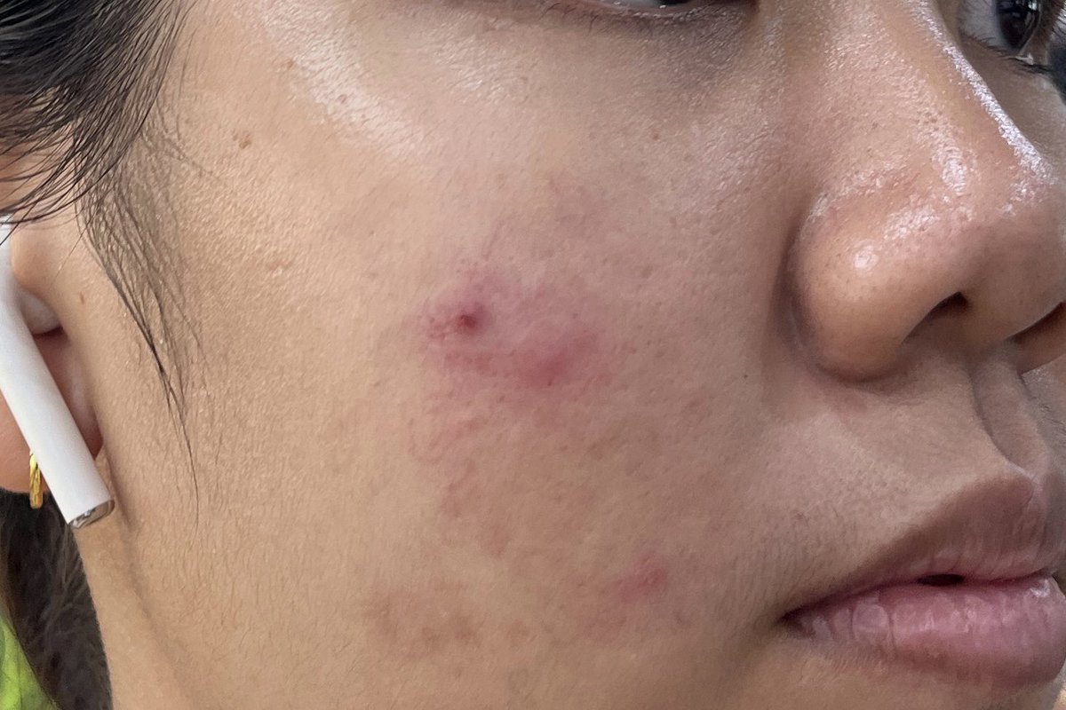 PJSahutsaya's tweet photo. ขอมาป้ายยาตัวนี้หน่อยเถอะ ANTI-ACNE MARK เซรั่มลดสิวของ Euecrin มันดีมากเว้ยยย คือเราเป็นสิวเหมือนแพ้อะไรสักอย่าง แต่พอได้ลองใช้ตัวนี้ค���อทั้งสิวและรอยสิวคือหายว้าบผิวดีมาก ชอบ #ดีบอกต่อ ซื้อได้เลยที่ https://t.co/yYsIv8yVur https://t.co/1hgrzW0m1r