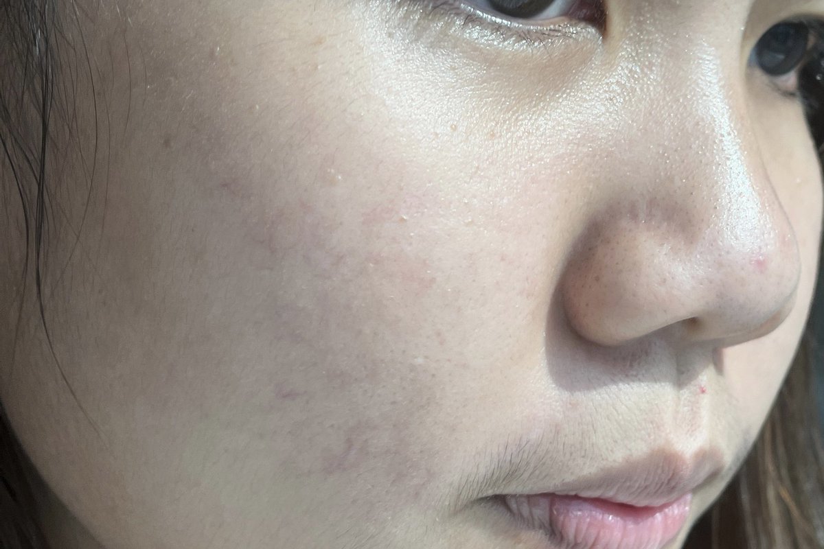 PJSahutsaya's tweet photo. ขอมาป้ายยาตัวนี้หน่อยเถอะ ANTI-ACNE MARK เซรั่มลดสิวของ Euecrin มันดีมากเว้ยยย คือเราเป็นสิวเหมือนแพ้อะไรสักอย่าง แต่พอได้ลองใช้ตัวนี้ค���อทั้งสิวและรอยสิวคือหายว้าบผิวดีมาก ชอบ #ดีบอกต่อ ซื้อได้เลยที่ https://t.co/yYsIv8yVur https://t.co/1hgrzW0m1r