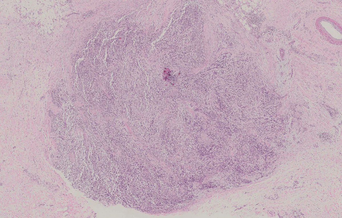 Young female, occipital scalp lesion. Differential diagnosis? How would you work it up? 
More pics & Answers: kikoxp.com/posts/15912 
More posts from Dr. Yang @HENRYY_MD: kikoxp.com/henry_yang2 
#pathology #pathTwitter #medTwitter #dermpath #BSTpath