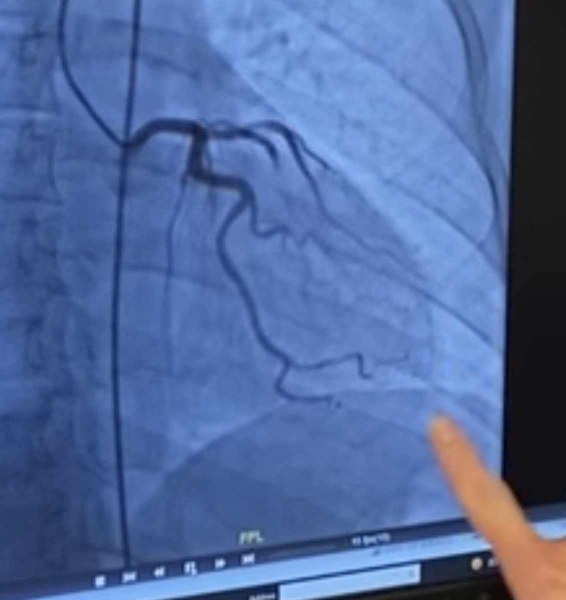 I soon found out I had a #SCAD - Spontaneous Coronary Artery Dissection. SCAD is rare, only 4% of HAs. But over 90% of SCADs are in women, either their 40s-50s or pregnant women. My primary artery to the left side of my heart had torn and blocked blood flow to part of my heart.