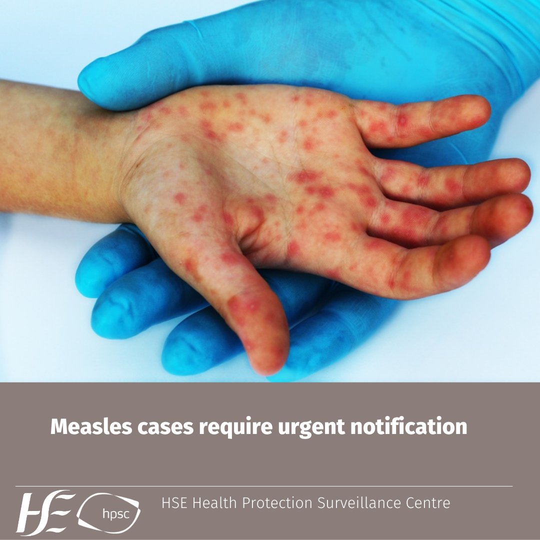 Measles has been added to the list of infectious diseases requiring immediate preliminary notification by telephone to a Medical Officer of Health. For more info, read the June Issue of Epi Insight 👉🔗bit.ly/3p64bzN