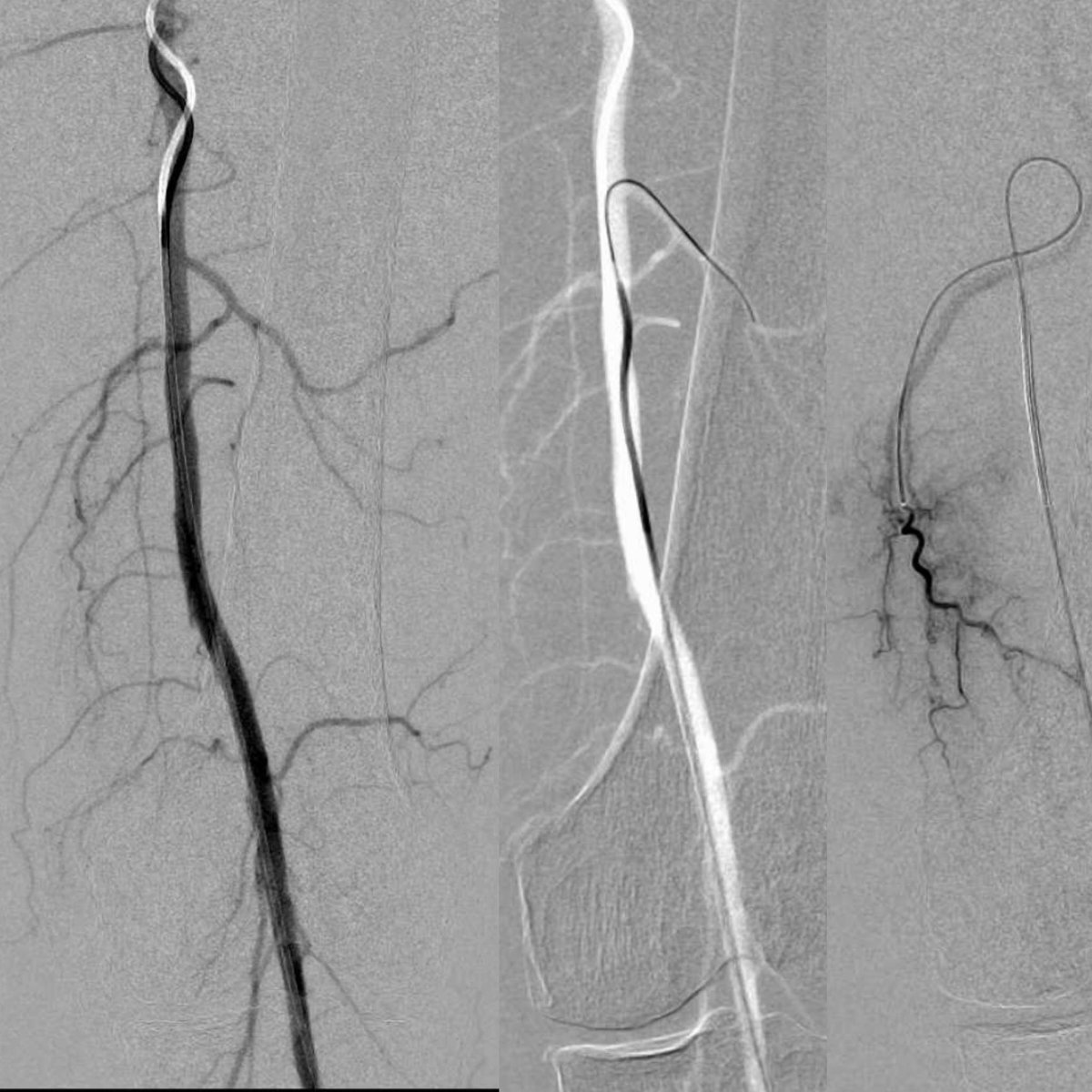 Sandeep Bagla MD (@sandeepbaglamd) on Twitter photo #GAE tips and tricks <a href="/StreamMeeting/">STREAMmeeting</a> 2023! The lateral takeoff of a GDA and medial swing!! How to recognize, cannulate and treat…note the multiple SMGA as well. Which ones are key in patients with arthofibrosis, hemarthrosis and OA? Come hear from the experts this September! #GAE tips and tricks <a href="/StreamMeeting/">STREAMmeeting</a> 2023! The lateral takeoff of a GDA and medial swing!! How to recognize, cannulate and treat…note the multiple SMGA as well. Which ones are key in patients with arthofibrosis, hemarthrosis and OA? Come hear from the experts this September!