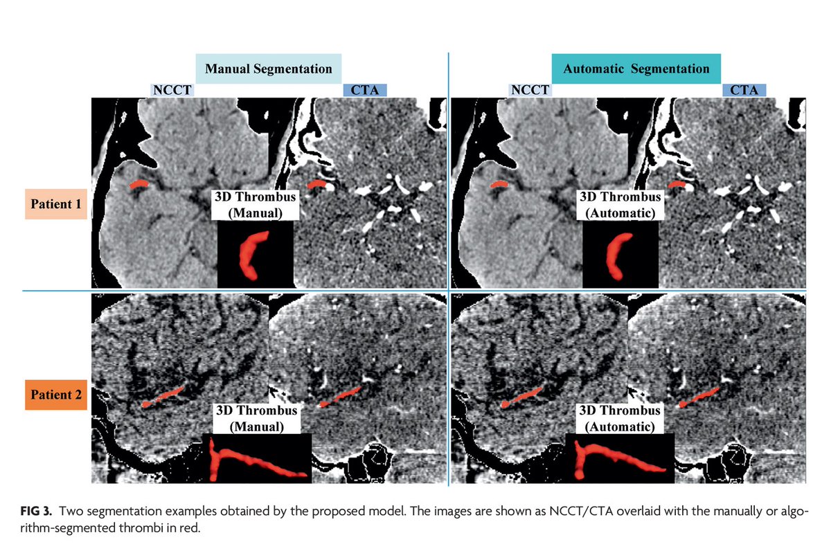 'Automated Segmentation of Intracranial Thrombus on NCCT and CTA in Patients with Acute Ischemic Stroke Using a Coarse-to-Fine Deep Learning Model' #Stroke #DeepLearning #OpenAccess #EditorsChoice | bit.ly/42Dl9mX