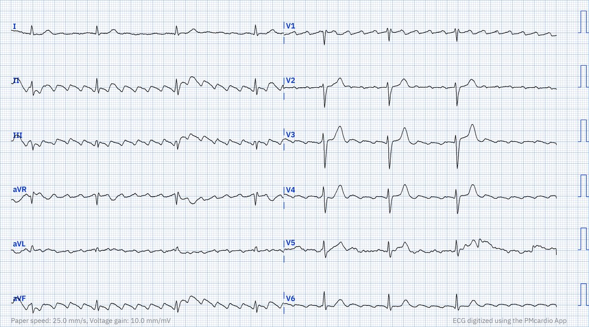 RobertHermanMD's tweet photo. Easy #ECG for mid-week — or is it?
What is your interpretation?

#CardioTwitter #FOAMed https://t.co/nWpizJrKKV