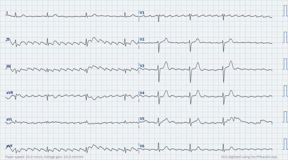 Easy #ECG for mid-week — or is it? What is your interpretation? #CardioTwitter #FOAMed