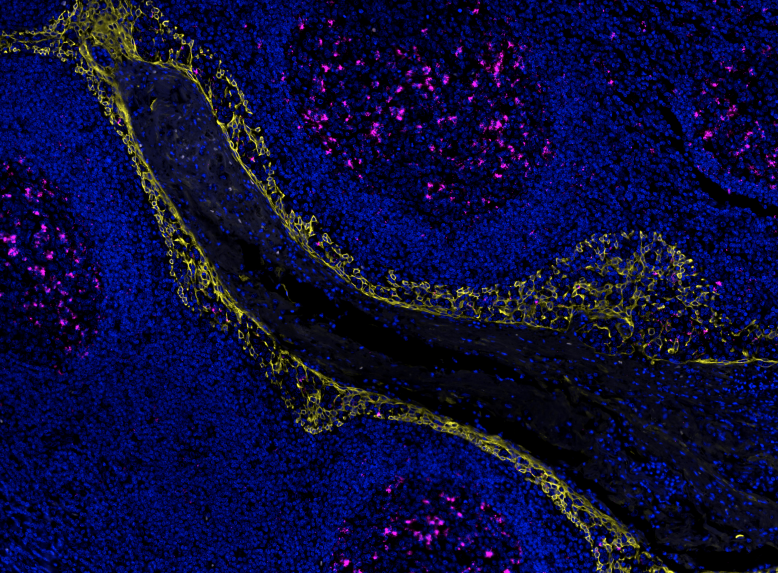 Interested in PD1/PD-L1 interaction detection?

PDL1 is a commonly used biomarker, but its correlation with immunotherapy outcomes isn’t always linear. 

Navinci's new PD1/PD-L1 Atto647N kit solves this challenge. 

1/2