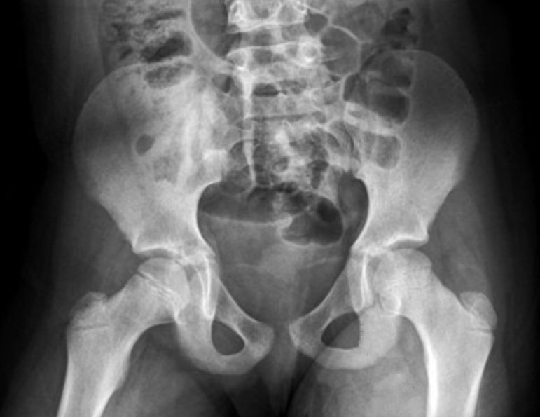 🛑You're working in a remote area &other than radiography,no other imaging modality such as U/S,CT or MRI is available.

They don't want official report & only asked you:
'Is there any PELVIC EFFUSION in this radiograph?' 

✴️What's your answer?How can you justify your answer?