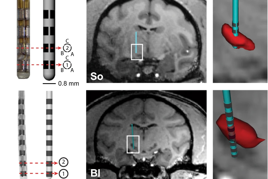 A recent study led by Prof. Matt Johnson and published in Scientific Reports provides neuroanatomical insights for selecting electrode configurations when treating Parkinson’s disease. #DBS #brainstimulation

Read more: bit.ly/3CvD5VS