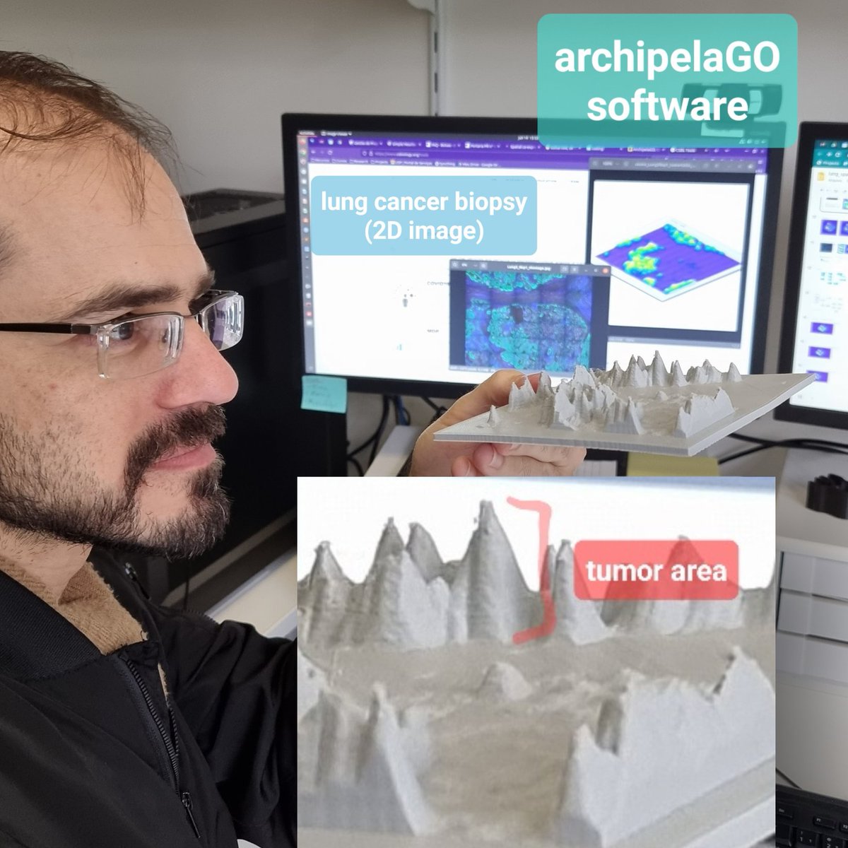 helder_nakaya's tweet photo. A lung cancer biopsy depicted as a mountainous terrain! Flood it and you've got an archipelago showing where tumor cells are. This is our software in development, turning spatial transcriptomics data into a 3D archipelago. https://t.co/xM3pAq3eMr