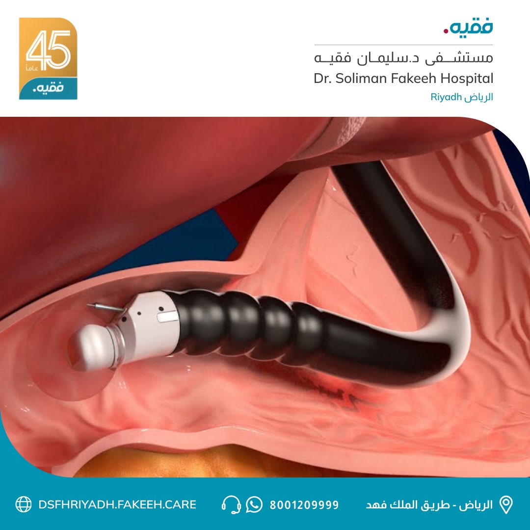 DSFHRIYADH's tweet photo. قام الفريق الطبي بقيادة د. عمار العتيبي بإجراء أول عمليات منظار الجهاز الهضمي بالأشعة فوق الصوتية في مستشفى الدكتور  سليمان فقيه - الرياض والذي يستخدم في تشخيص العديد من الحالات مثل أورام الجهاز الهضمي, التهابات البنكرياس, حصوات القنوات المرارية وغيرها من الحالات المرضية. https://t.co/QFIMbDMdAT