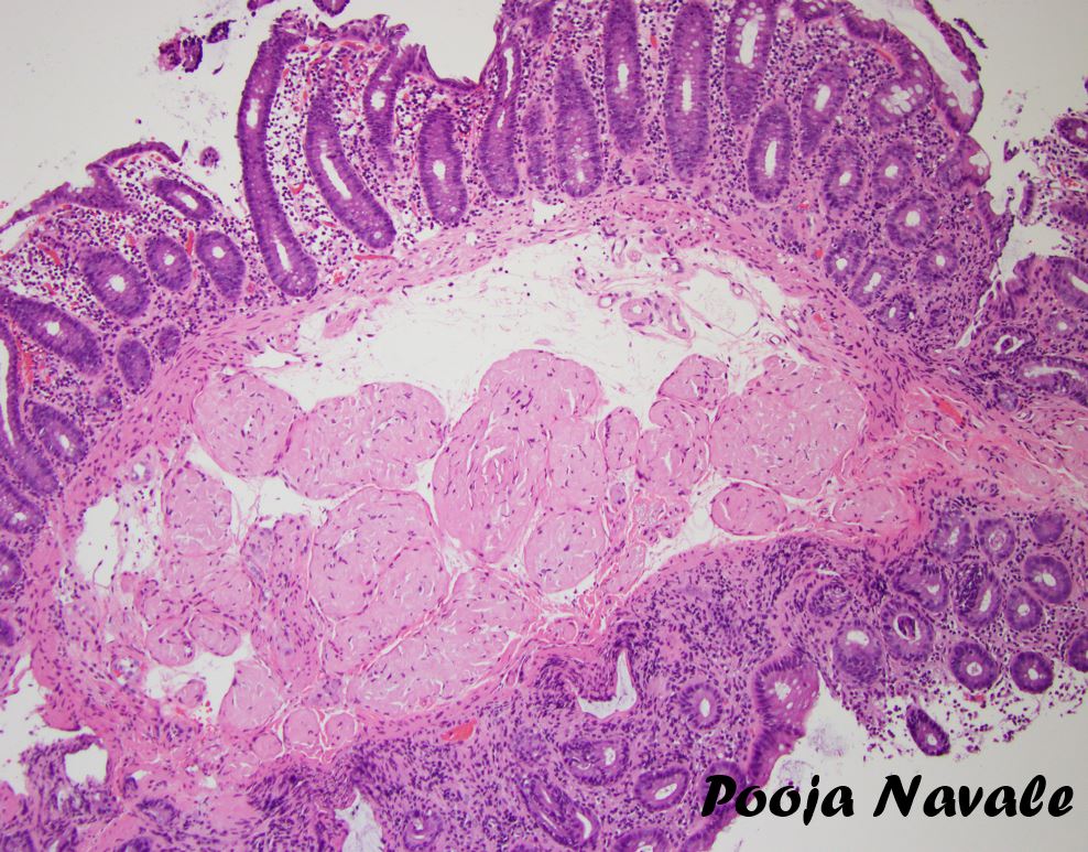 navale_pooja's tweet photo. Gastrointestinal amyloidosis 
50 year old female, a poll (with answers)

#pathtwitter #MedTwitter https://t.co/BgnLB4MGNk