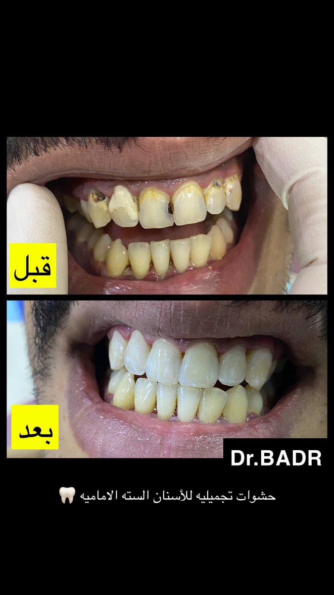Dr_BADR11's tweet photo. لأحد مرضاي تم عمل حشوات تجميلية فقط للأسنان الست الأماميه https://t.co/zqCFVJEkEn