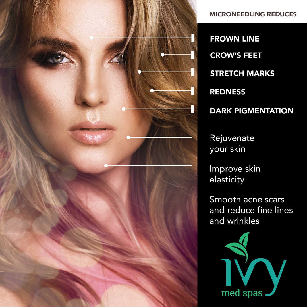 ivymedspas's tweet image. Booking Fast! 

Microneedling: Unleash skin rejuvenation! 

Say goodbye to imperfections like lines, scars, and pigmentation. 

Call us today and book your session! ✨🌟💆‍♀️ 

bit.ly/3oK1GDf

#conciergeiv #conciergeivtherapy #mobileiv 
#mobileivdrip #mobileivtherapy