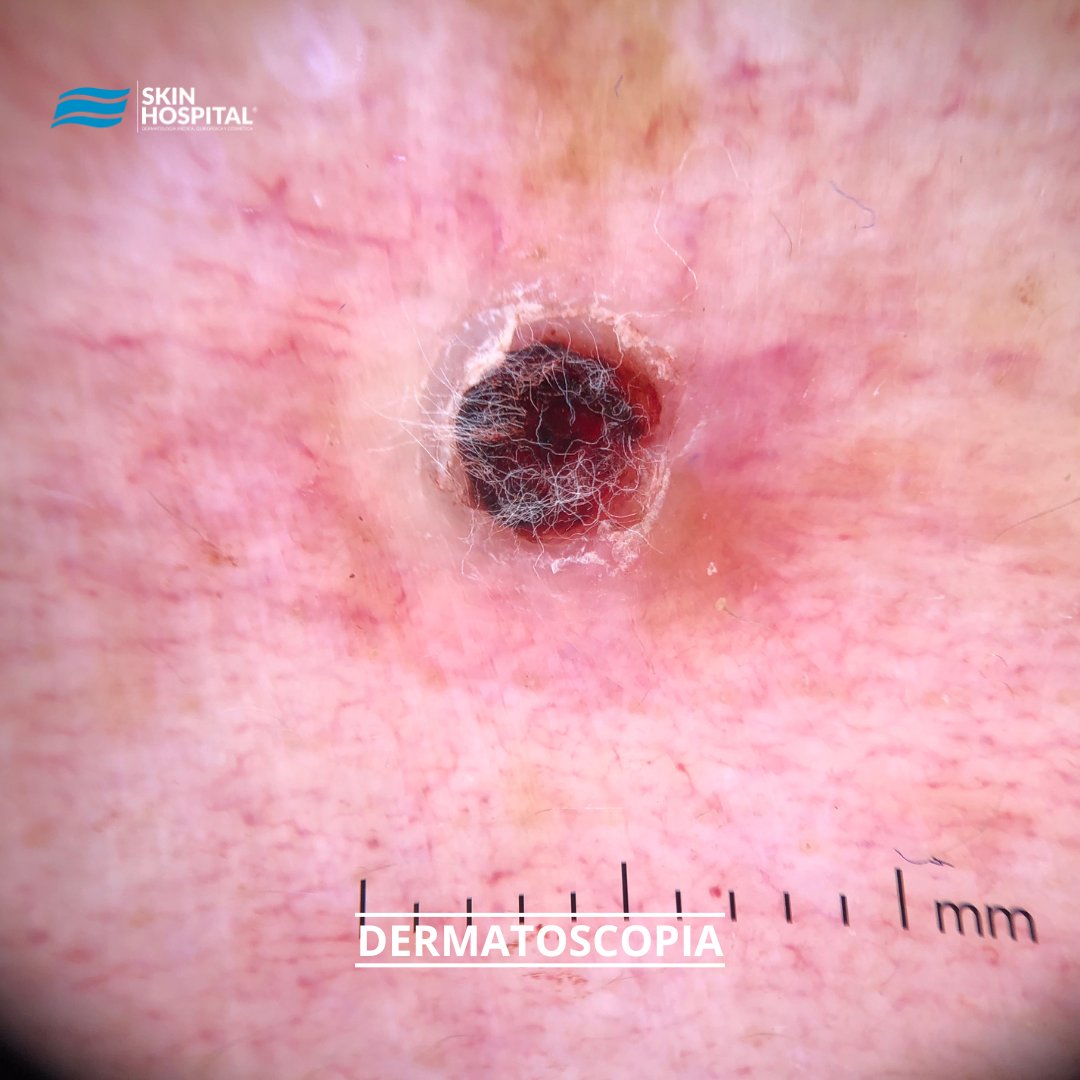 SkinHospital_mx's tweet photo. CUERNO CUTÁNEO
Es una proyección dura de la piel hecha por queratina compacta.  Aparecen sobretodo en las áreas expuestas al sol.

La importancia de los cuernos cutáneos radica en que debajo de ellos puede haber una lesión benigna, premaligna o un cáncer de piel.
#skinhospital https://t.co/Uk4xd8G2Oj