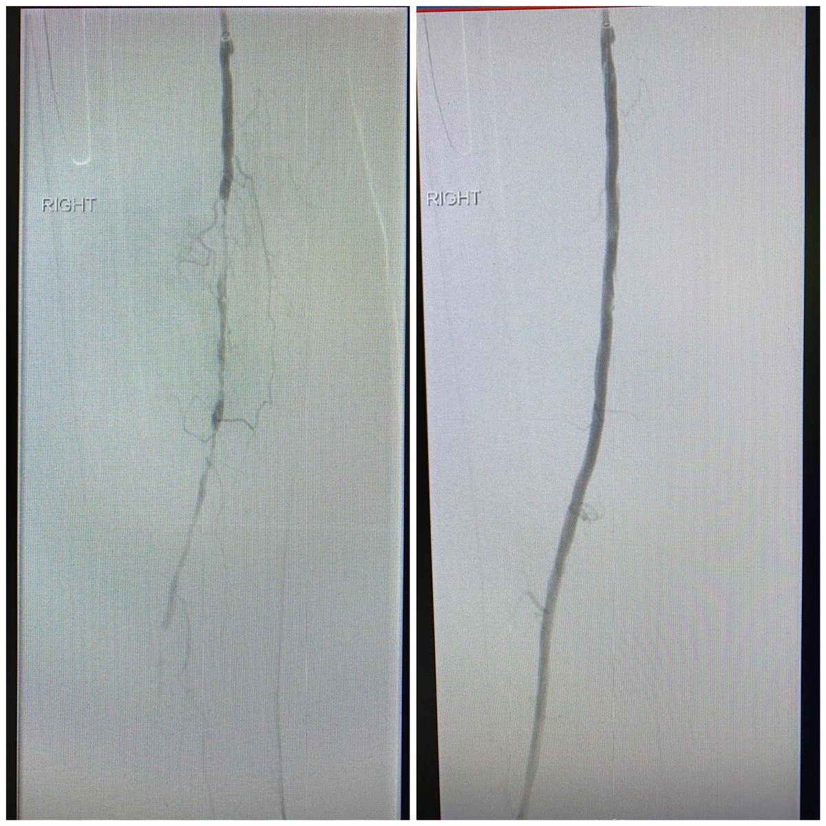 Great to see HawkOne™ Directional Atherectomy System, followed by IN.PACT™ Admiral™ DCB being used for  patients with #PAD in the SFA.  #MedtronicEmployee #INPACTDCB #HawkOne | See risks: bit.ly/3KAlKPe| bit.ly/3MowClV