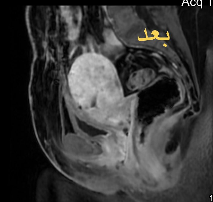 مريضه في الاربعين من العمر و  كان مقرر لها استئصال الرحم بسبب #ألياف_الرحم  حجم ١٤  سم.
 تم علاجها و لله الحمد عن طريق #القسطرة و #الأشعة_التداخلية و توقف جميع الاعراض و عودة الرحم الى حجمه الطبيعي و اختفاء الورم الليفي الحميد مع الحفاظ على الرحم #بتخدير_موضعي و #بدون_جراحة