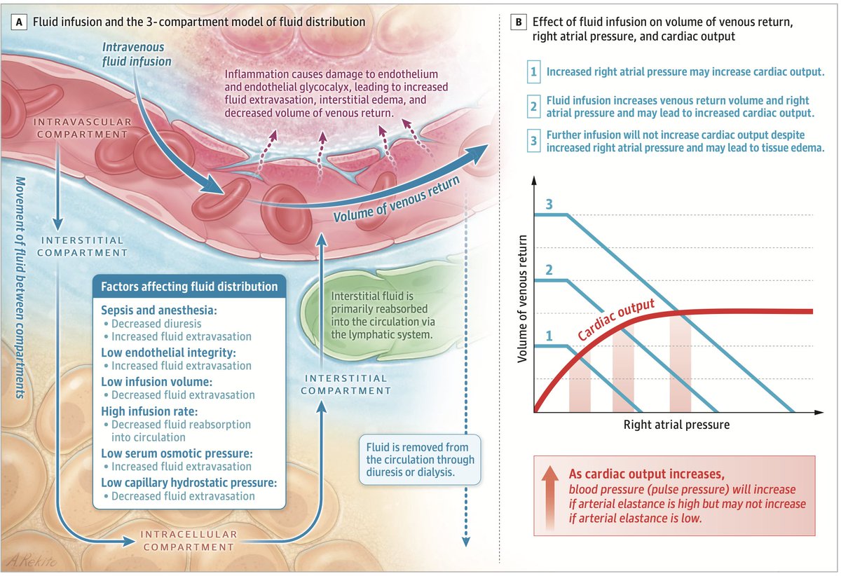 Narrative review on fluids in sepsis

From resuscitation to evacuation
From EGDT to #CLOVERStrial
From fluid responsiveness to fluid intolerance

All the essence is compacted in this paper!
Fluid therapy in sepsis is really interesting😊

🔗jamanetwork.com/journals/jama/…
#FOAMcc