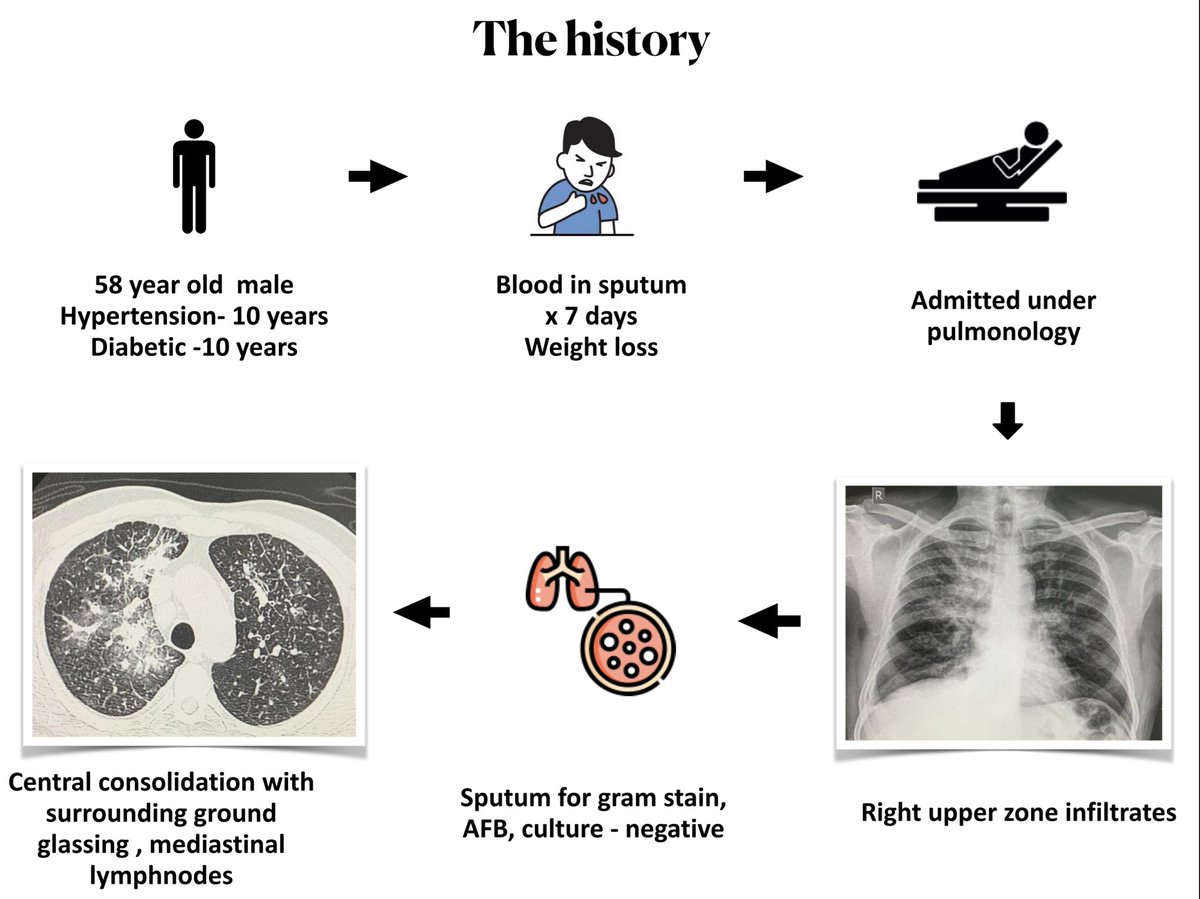 🔥 Let’s discuss an interesting case . Already discussed in #ECNeph . Trying to consolidate it. 

 🏥  I was called in for a nephrology consult for a patient admitted under pulmonology  🫁 

🩸 Microscopic hematuria ++