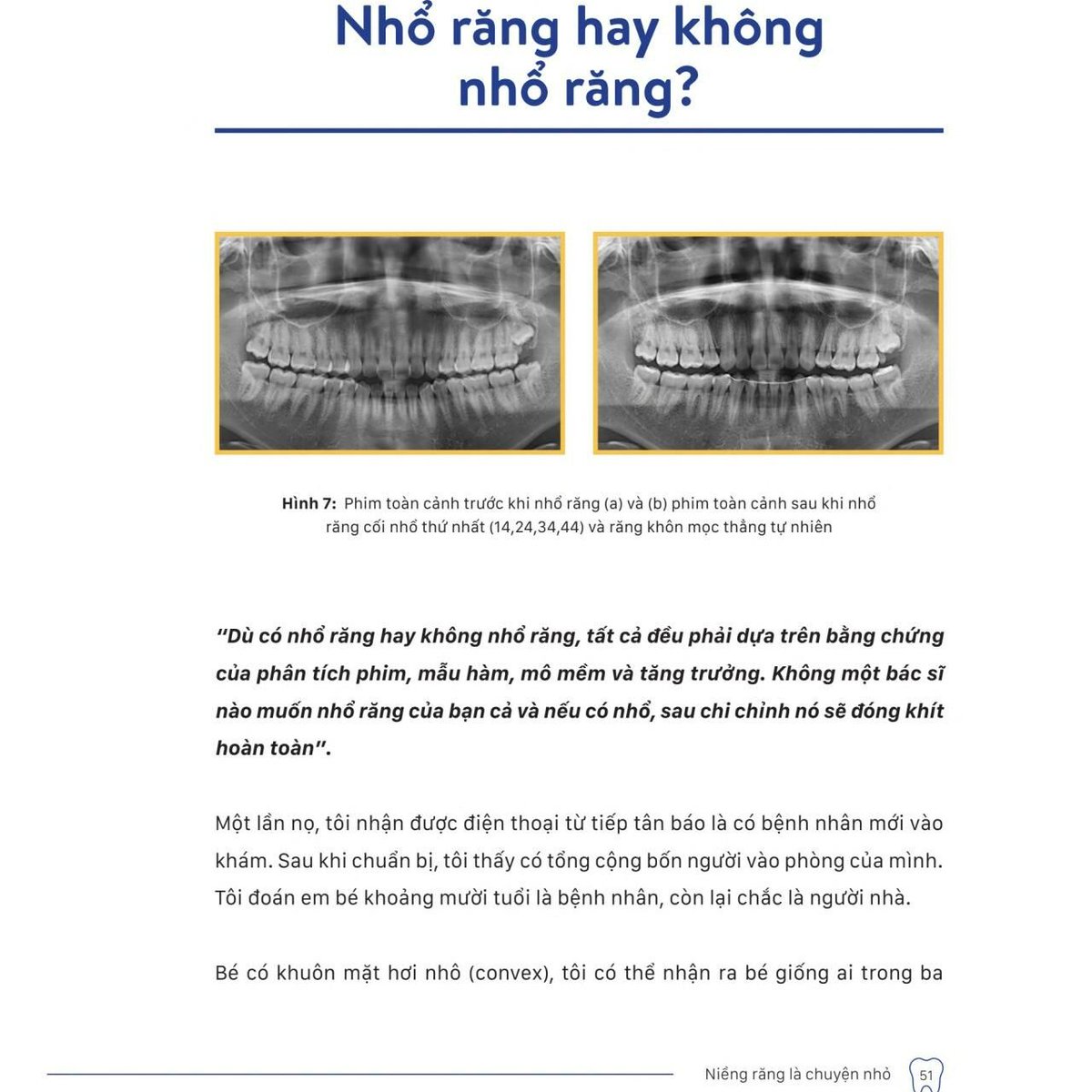Nhổ răng hay không nhổ răng ?