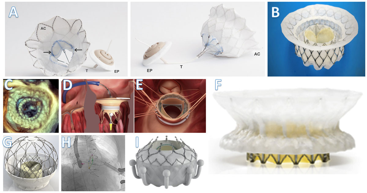 Free CME! In the U.S. TMVR systems are being studied but are not ready for commercial use outside clinical trials. Read more 'Transcatheter Mitral Valve Replacement with Dedicated Devices' by @Joe_Aoun_ @MReardon19 @SachinGoelMD 

#DeBakeyCVJournal doi.org/10.14797/mdcvj…