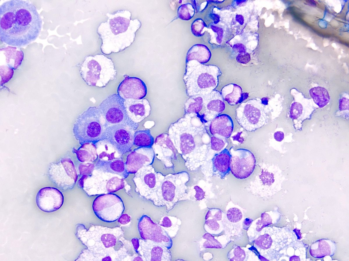 Pleural fluid in a patient with history of of #AML. It’s imperative to review the peripheral blood flow cytometry or smear in cases with abundant red blood cells. Some of  these cells are suggestive of blasts; however, peripheral blood contamination cannot be excluded. #CytoPath